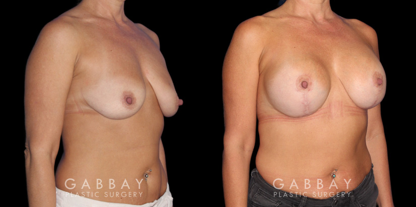 Wise Mastopexy with Silicone Breast Implants