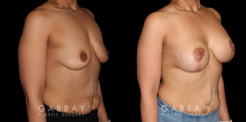 Breast Augmentation – Silicone & Lift