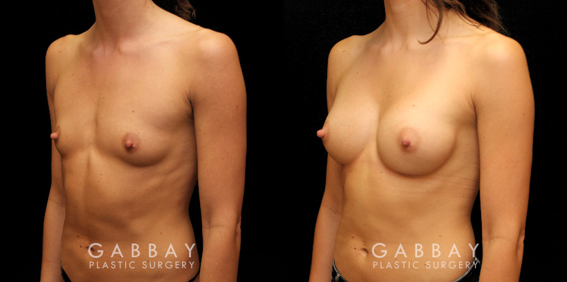 This is an extremely athletic woman who wanted a softer look for her torso. She had silicone breast augmentation using Allergan Natrelle soft touch moderate profile implants placed through a lower breast/inframammary incision and under her muscle in a dual plane position.. Her implants were 255 cc.