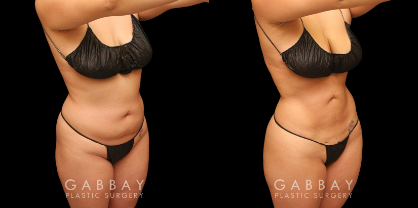 Female abdominal fat removal results showcasing a patient's flatter tummy area, with no side effects from the liposuction procedure. The fat removed is permanently gone, with straightforward maintenance of results.