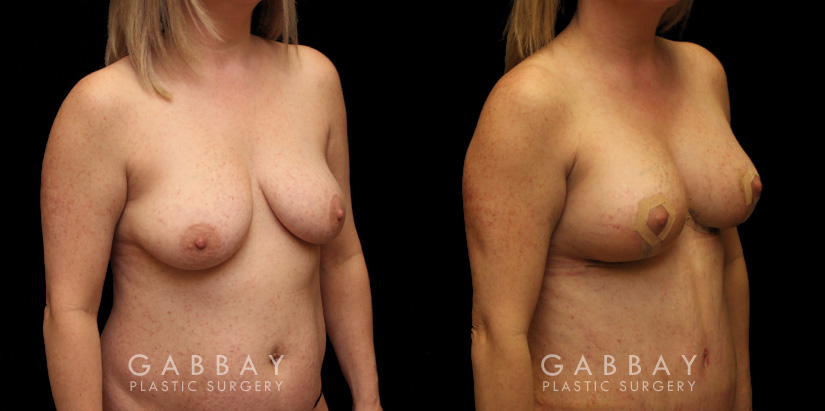 Breast aug/pexy and tummy tuck