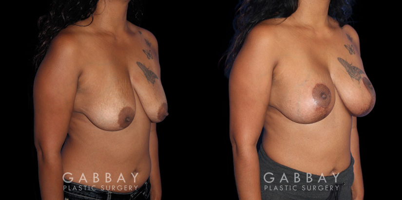Patient 21 3/4th Right Side View Wise Mastopexy with Silicone Breast Implants Gabbay Plastic Surgery