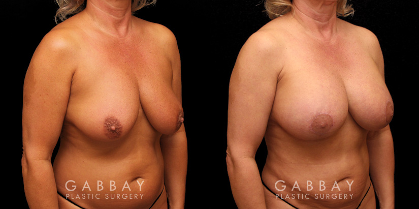 Breast Aug/Pexy with Liposcution and J-plasma to the Full Abdomen and Upper Back Bra Roll
