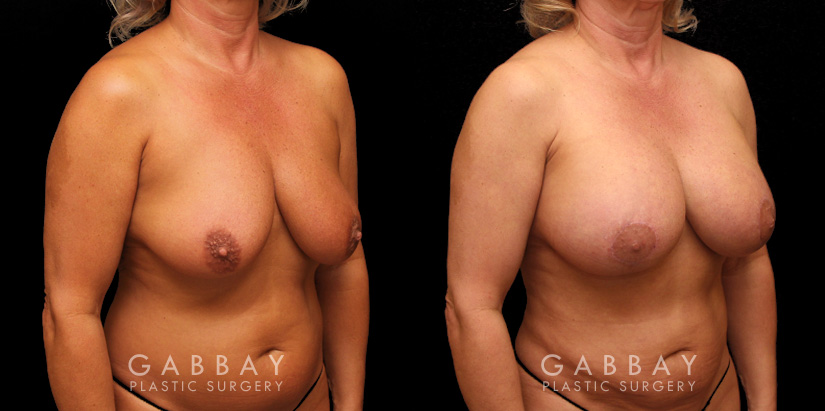 Breast Aug/Pexy with Liposcution and J-plasma to the Full Abdomen and Upper Back Bra Roll