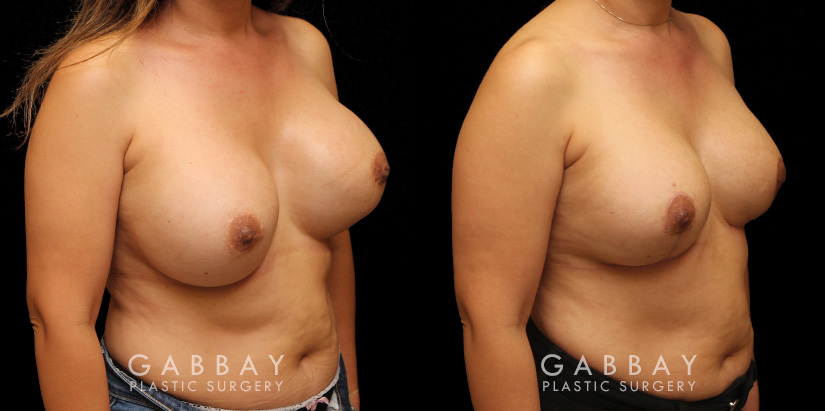 Patient 12 3/4th Right Side View Augpexy Gabbay Plastic Surgery