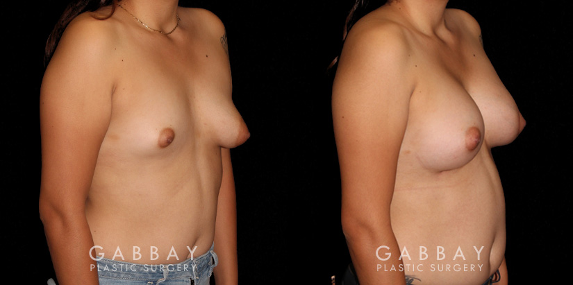 Patient 13 3/4th Right Side View Augpexy Gabbay Plastic Surgery