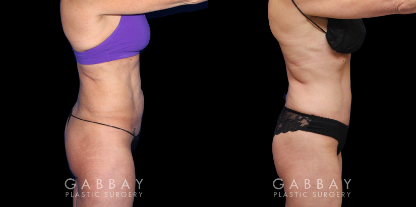 Before and after photos for body procedures, including a tummy tuck and inner thigh liposuction. Combining the procedures resulted in a flatter, smoother abdomen balanced with subtle yet effective tightening of the thighs. The final result evokes a more youthful contour.