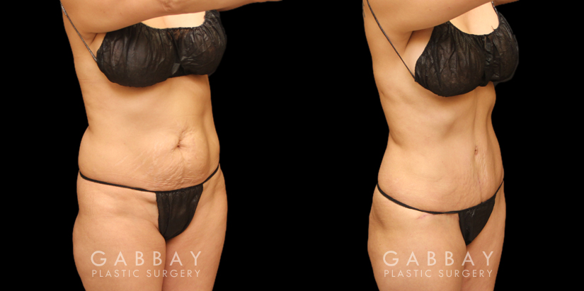 Before and after combined tummy tuck and liposuction of the abdomen, back bra roll, and waist. This 360-degree approach resulting in a balanced outcome, slimmed profile, and fitter looking contour. The patient recovered smoothly from the multi-procedure surgery and healed on schedule.