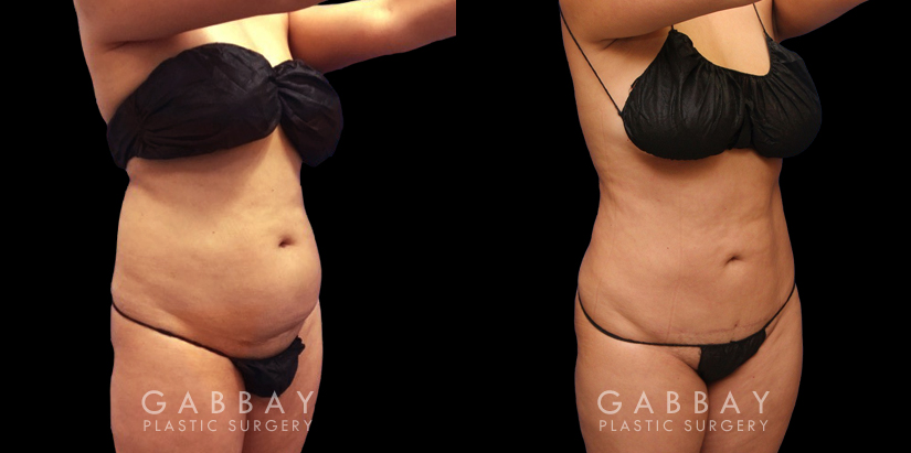 Results of a safe abdominal liposuction surgery that provided this female patient with notable slimming. Note the flat stomach from the profile view with no overhang above the waistline.