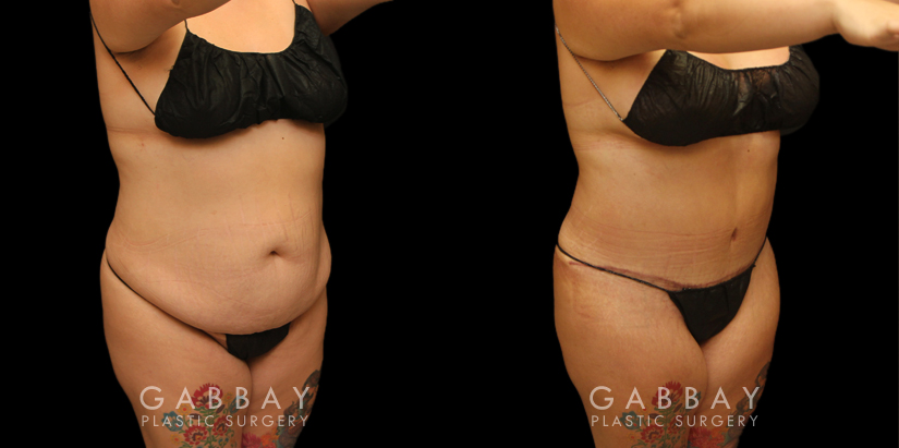 Patient 13 3/4th Right Side View Tummy Tuck with Lipo/Breast Aug/pexy Gabbay Plastic Surgery