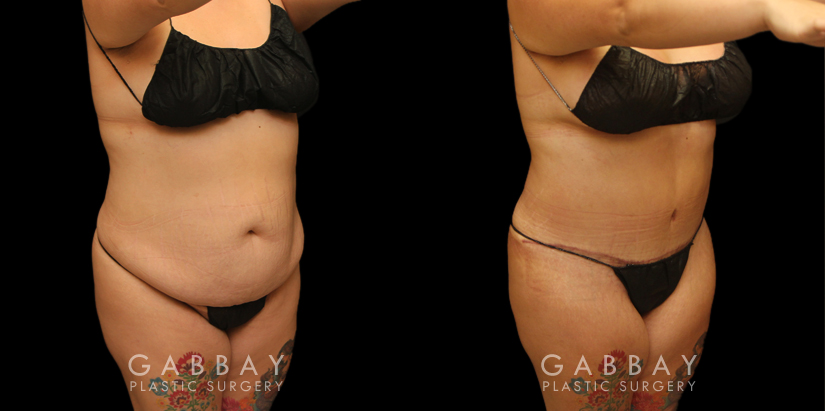 Tummy tuck before and after photos, along with combined liposuction, breast lift, and breast augmentation. Abdominal tightening enhanced the increase in breast volume for a curvier, fitter aesthetic.