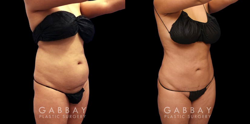 Abdominoplasty before and after photos post-recovery. Patient’s healing went smoothly, resulting in a firmer, tighter abdominal region, with a refined contour particularly visible in side profile.