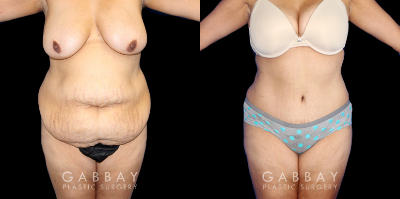 Patient results after liposuction to the back bra roll with significant abdominal tightening. Note the decrease in volume of abdominal fat and excess skin, with no visible scarring from any angle. Patient achieved a flat profile silhouette absent of any folds.