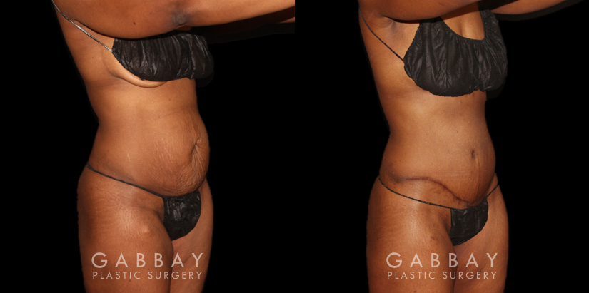 Patient following tummy tuck and hernia repair, showcasing results from multiple angles. Note the absence of stomach overhang in the leaning forward position, demonstrating effective tightening of multiple tissue layers.