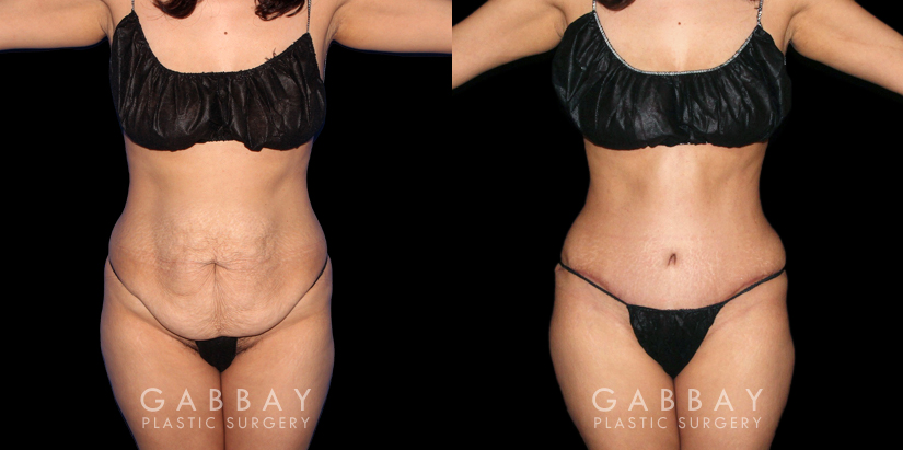 Multi-angle view of patient before and after tummy tuck combined with waist and arm liposuction. The combined approach allowed for results that balanced well with each other, creating a firmer body contour that maintained a natural look.