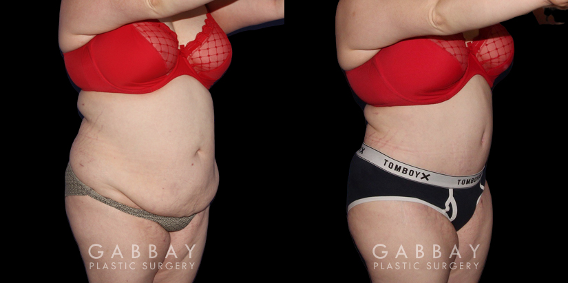 Patient before and after her tummy tuck procedure combined with liposuction around the waist. The final effect is slimming from multiple angles with no visible scarring. Note the smoother texture of skin and lending to a more youthful visual.