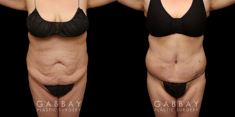 Patient before and after tummy tuck combined with breast lift. The tightening of the abdomen along with the repositioning of the breasts creates a more balanced aesthetic with tighter skin.