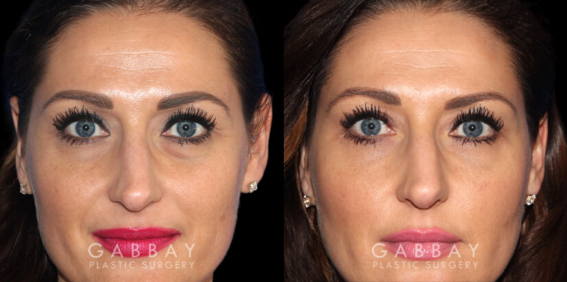 Patient 01 Front View Upper Eyelid Blepharoplasty with Fat Transfer to Face Gabbay Plastic Surgery