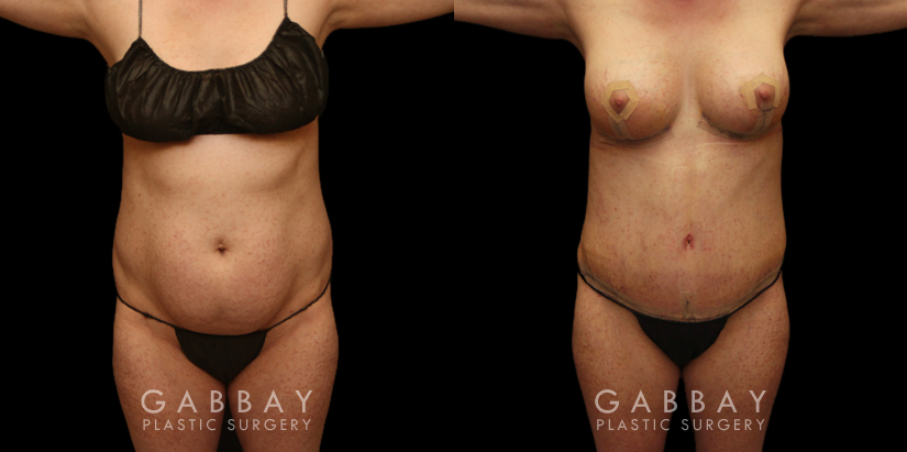 Patient 24 Front View Breast Aug/Pexy and Tummy Tuck Gabbay Plastic Surgery