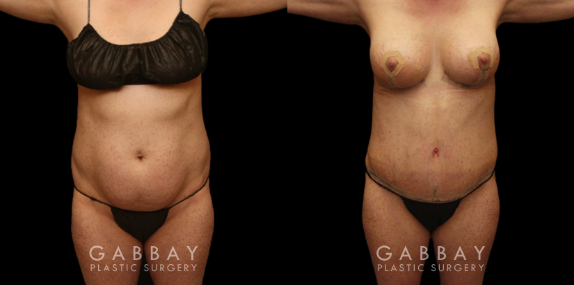 Patient before and after tummy tuck combined with breast augmentation and breast lift. By increasing breast volume, heightening breast position, and tightening the abdominal area, the patient has a slimmer, yet feminine figure.