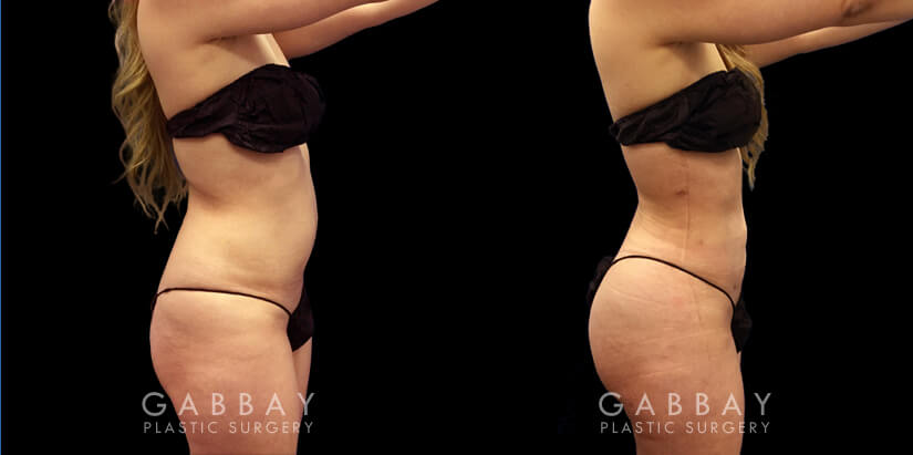 BBL surgery results for female patient after the fat injections fully settled. Note the significant increase in buttocks volume without the use of butt implants, resulting in a rounded, lifted shape that curves into the small of the back for an enhanced contour. Around the waist, back, and abdomen, 360 liposuction provided a smooth slimming effect that emphasizes the full roundness of the butt.