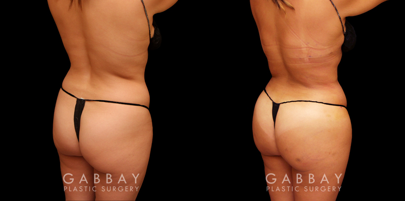 Back and side view of female patient results before and after liposuction to abdomen and waist with fat transfer to butt. Lipo results provided abdominal and waist contouring, slimming the figure while providing increased volume and shape to the buttocks. All volume increase is from injections with no artificial implants used. Note natural appearance and lack of visible scarring.