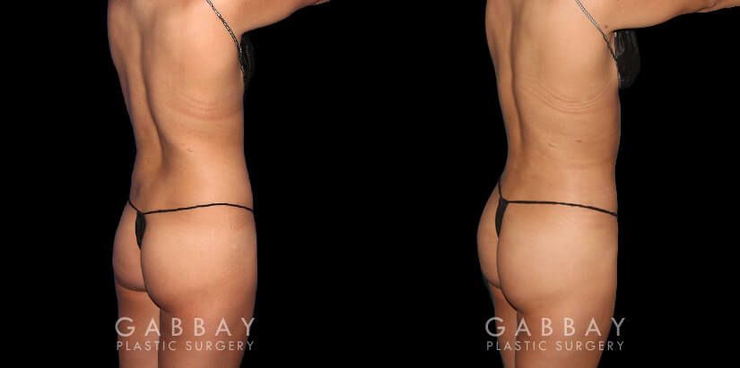Multiple angle view of Caucasian patient in her mid-30s before and after mini Brazilian butt lift surgery and combined 360 liposuction for body contouring and butt augmentation. Liposuction provided improved abdominal contouring focusing on the abdomen, waist, and tailbone areas. The transferred fat settled well into round-shaped buttocks for a stable cosmetic enhancement as part of this skinny BBL.