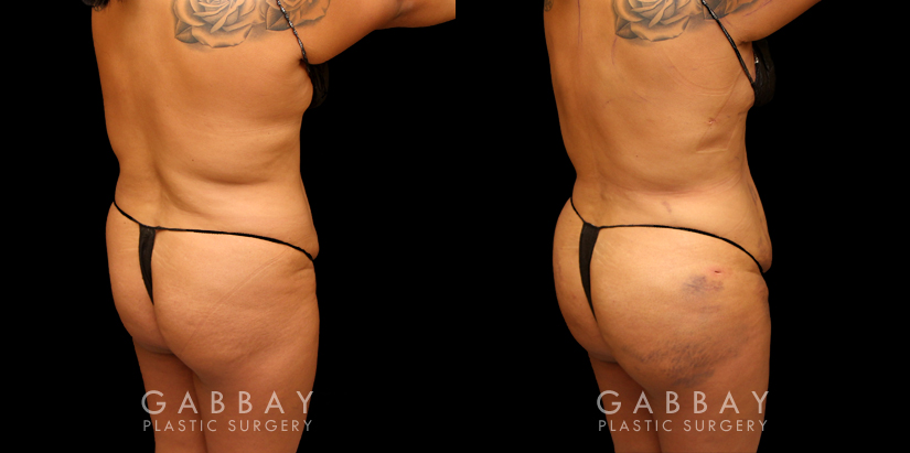 Patient 05 4/5th Right Side View Liposuction to Arms, Bbr, Flanks with FT to Buttocks Gabbay Plastic Surgery