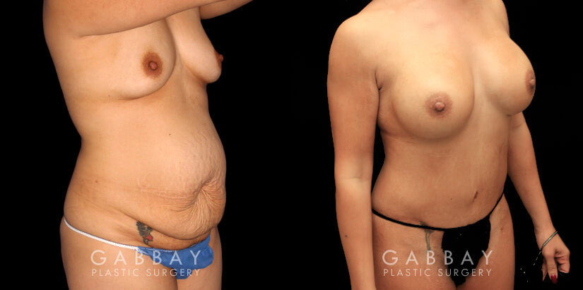 Mommy makeover before-and-after showing tightened abdomen, increased breast size and improved shape, and significant fat reduction for a slimmer contour. This patient’s mommy makeover involved 360 liposuction, a tummy tuck, and breast augmentation. All procedures were completed in a single visit and she saw a smoother recovery with complete healing on time. Note the lack of visible scarring from each angle.