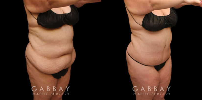 Patient photos from before and after tummy tuck. The full procedure combined abdominal tightening with liposuction, resulting in significant slimming of the front. Patient recovered smoothly with no complications.