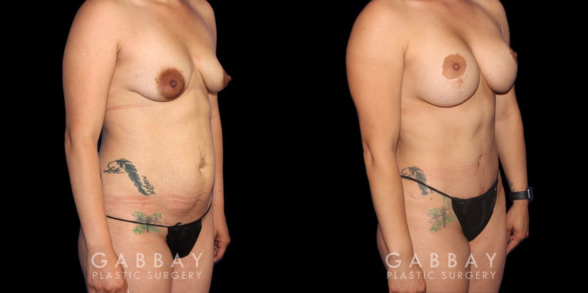 Before and after a mommy makeover consisting of abdominoplasty, breast augmentation, and a breast lift. Using targeted liposuction, created a smoother abdominal contour while also repositioning the breasts with a lift combined with augmentation for improved size and shape.The breast lift also moved the nipples to a higher, symmetrical point. Patient recovery was smooth without complications.