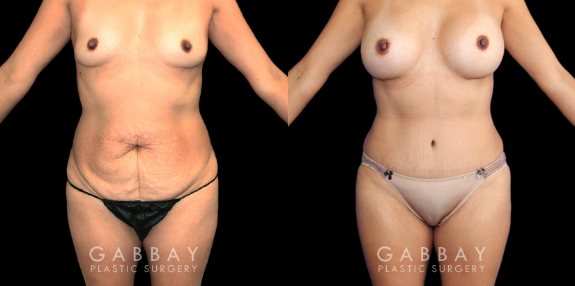 Mommy makeover patient before and after a combination procedure of breast augmentation (silicone implants), tummy tuck, and flank liposuction. When combined, the procedures restored a firmer body contour while enhancing the aesthetic of the breasts with no visible scarring, improving symmetry in shape and size. Patient had a smooth recovery.