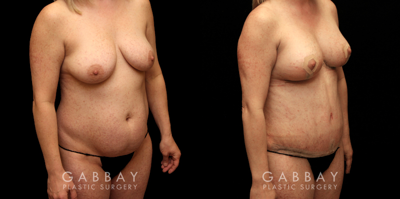 Before and after a mommy makeover consisting of two procedures: tummy tuck and a breast lift. Drooping breasts were repositioned to a higher, firmer aesthetic while targeted abdominal liposuction and tightening restored a prepregnancy contour to the body and silhouette.