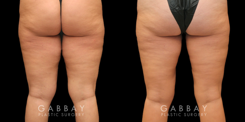 Patient 03 Back View Thigh Lift and Liposuction Gabbay Plastic Surgery