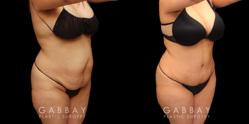 Patient photos from before and after tummy tuck. The full procedure combined abdominal tightening with liposuction, resulting in significant slimming of the front. Patient recovered smoothly with no complications.