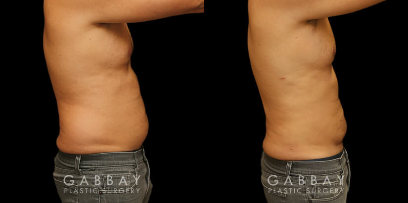 Late 30s male patient before and after male liposuction. Targeted fat removal resulted in a flatter abdomen and significant reduction of flank volume. Note the reduction of waist curves for a straighter silhouette.