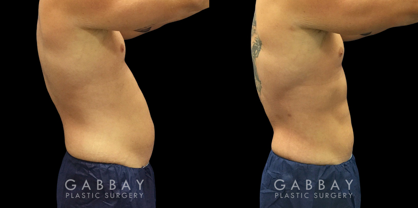 Patient 04 Right Side View Lipo Male Gabbay Plastic Surgery