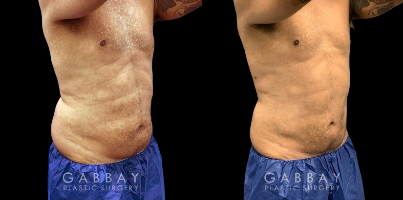 Male liposuction before-and-after photo for 360 lipo showing a result in a slimmer waist and flatter abdominal area for an enhanced torso contour. Flanks are significantly slimmed and present a toned silhouette.