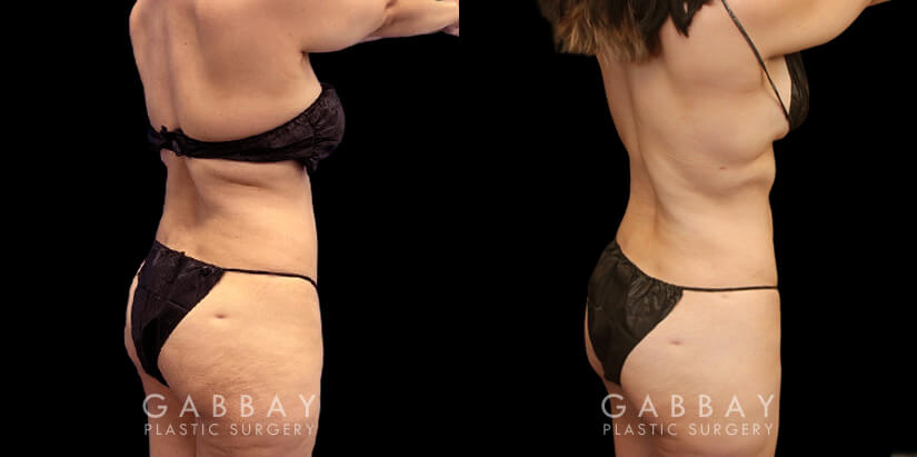 Before and after surgical liposuction for the abdomen, removing stubborn fat with minimal use of invasive techniques. Note the visible belly fat reduction for a smoother contour.