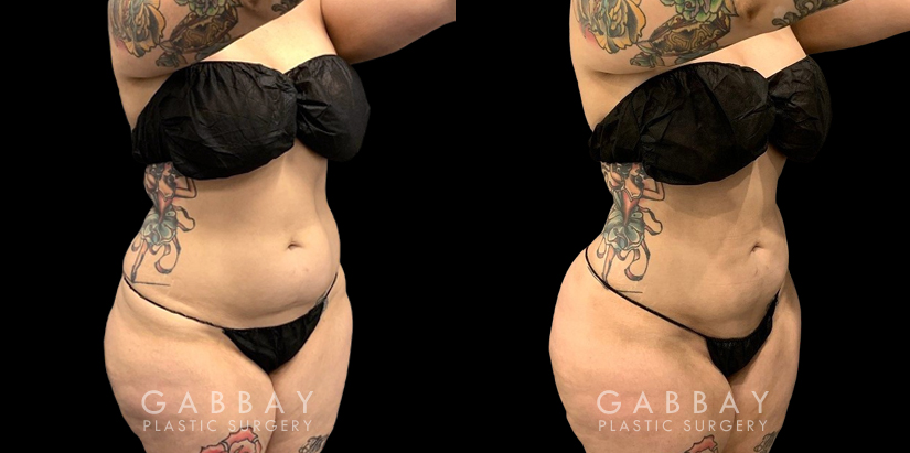 Female liposuction results for a flatter abdomen. Note how fat reduction was done with her natural figure in mind for results that match her unique features.