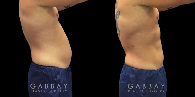 Active male patient wanted to target stubborn belly fat that would not disappear with exercise. Abdominal liposuction allowed him to achieve his target body shape and figure.