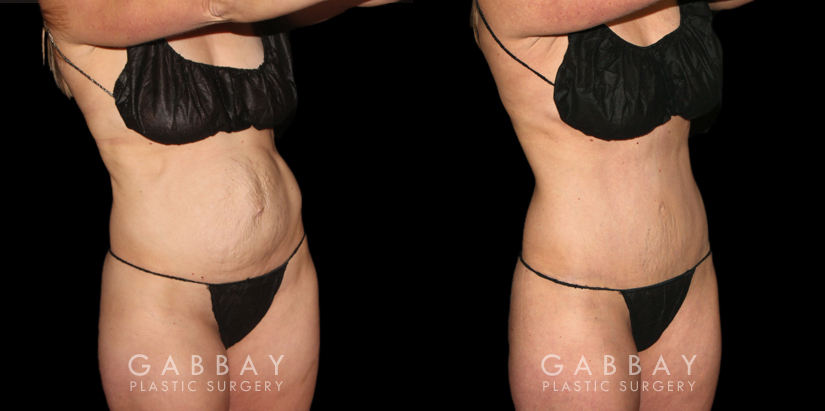 Patient results from tummy tuck. Note before the loose, hanging area at the lower abdomen. Following fat removal and abdominal tightening, the patient achieved a slim, refined silhouette.