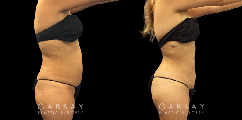 Female patient in her early 40s after abdominal liposuction surgery. Patient’s procedure was straightforward with an uncomplicated recovery period and notable results.