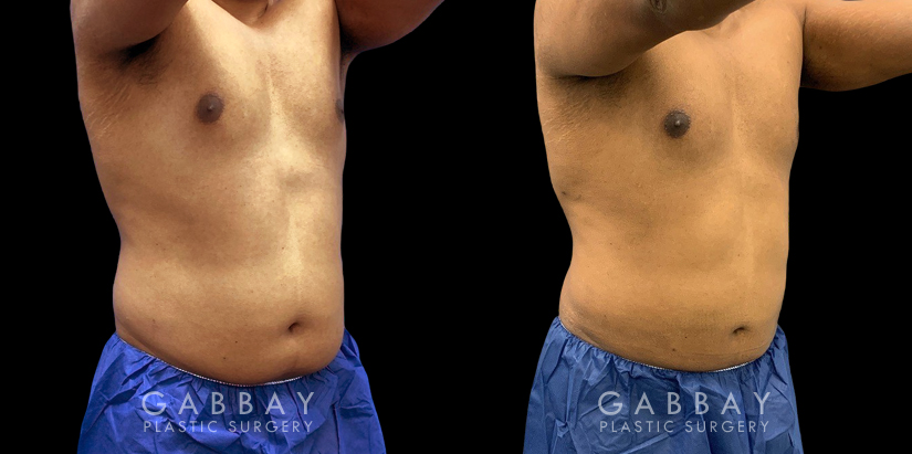 Male patient after surgical removal of abdominal fat. His liposuction results emphasize the naturally masculine form of his torso with a tighter figure overall.