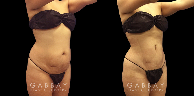 Female patient before and after belly liposuction, enhancing her figure while providing a flatter stomach visible from the side and front. Note the lack of visible scarring.