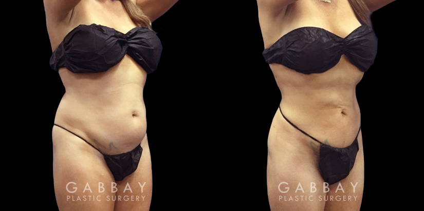 Following her abdominal liposuction, this female patient in her late 30s saw a smooth recovery period with results that gave her a significantly flatter stomach with no belly overhang.