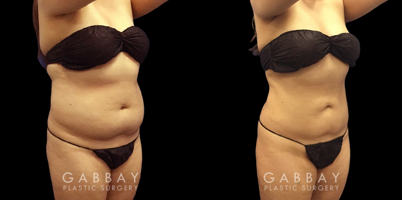 Patient’s surgical belly fat removal results reveal significant slimming after her procedure, with virtually no belly overhang for a flat profile contour.