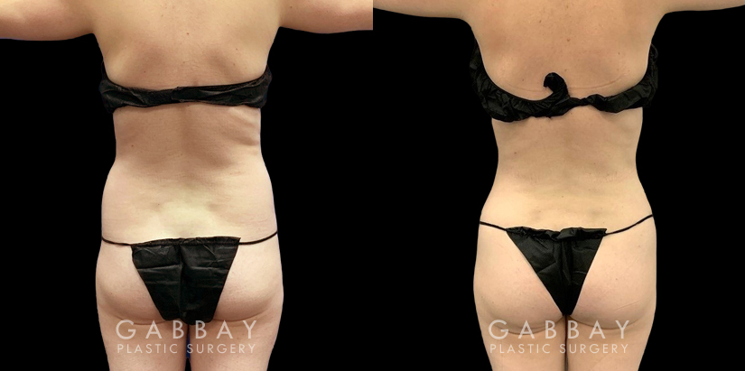 Female patient wanted to target stubborn belly fat. With one lipo procedure for her abdomen, she attained a smooth below with significant improvement and a smooth recovery experience.