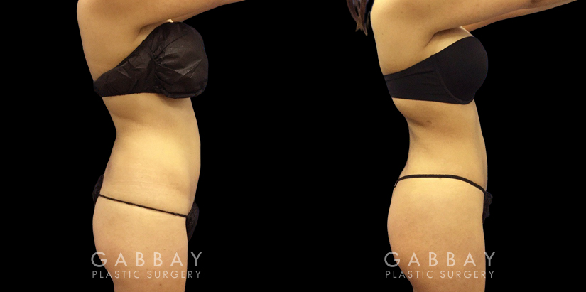 Female patient’s before-and-after photos showing how her abdominal lipo procedure enhanced her hourglass figure, slimming down both her waist and her stomach for a fit-looking contour from all angles.