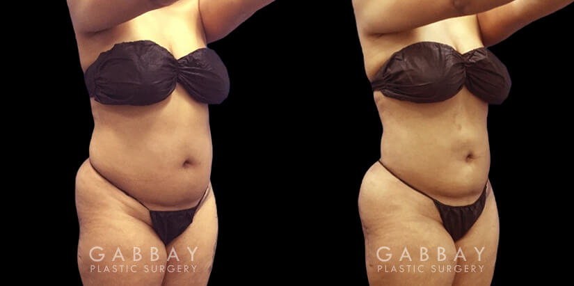 Female patient approaching her target body weight who wanted to remove stubborn fat that was resisting exercise. Abdominal lipo surgery allowed for encouraging slimming of her stomach and waist areas.
